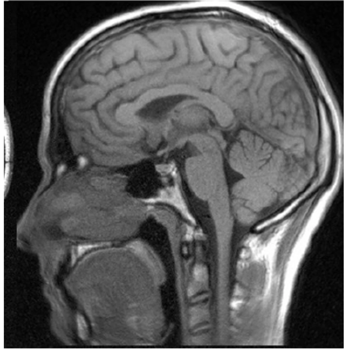 Brain MRI Image